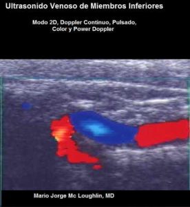 Ultrasonido venoso de miembros inferiores – Mc Loughlin, Mario Jorge [ePub & Kindle]
